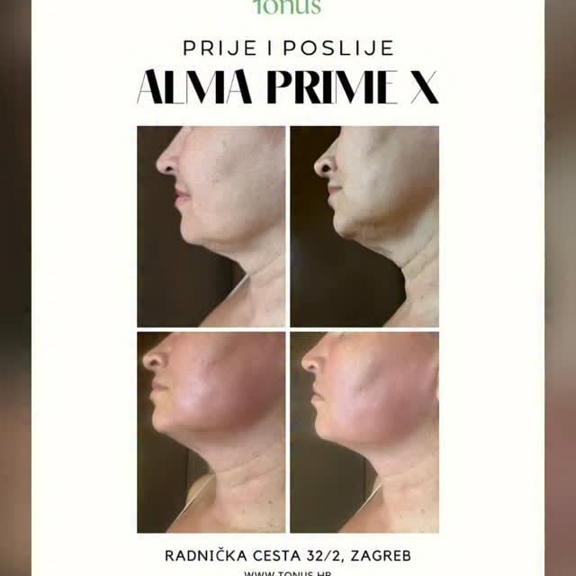 وصل لعندنا بمركز Eileen Beauty Clinic أحد أقوى أجهزة العالم لنحت وشد الجسم ✨ Alma PrimeX ت