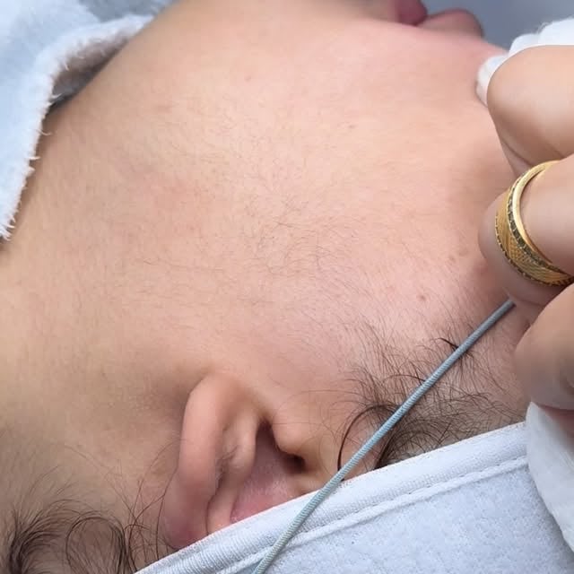 ليزر الحرق للوجه✨🔥 نتائج بتلاحظيها من اول جلسات 🔥 بشتغل فقط على الشعر البني الغامق او ال