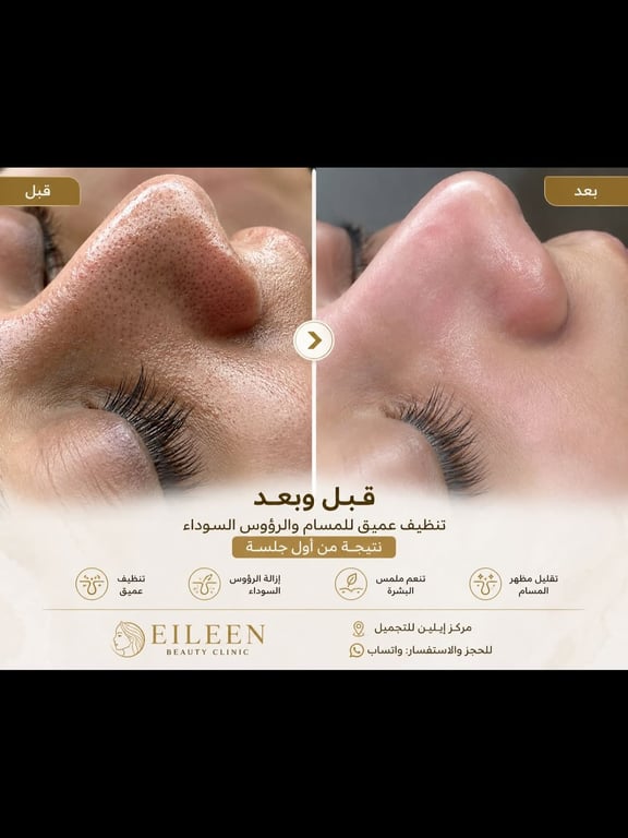 ✨ قبل وبعد تنظيف عميق للمسام والرؤوس السوداء