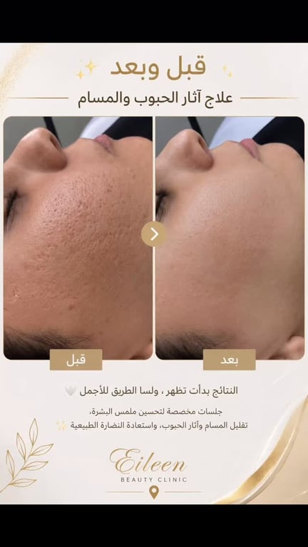 #أم_الفحم #تجميل_إيلين #عناية_بالبشرة #نضارة_البشرة #تجديد_البشرة